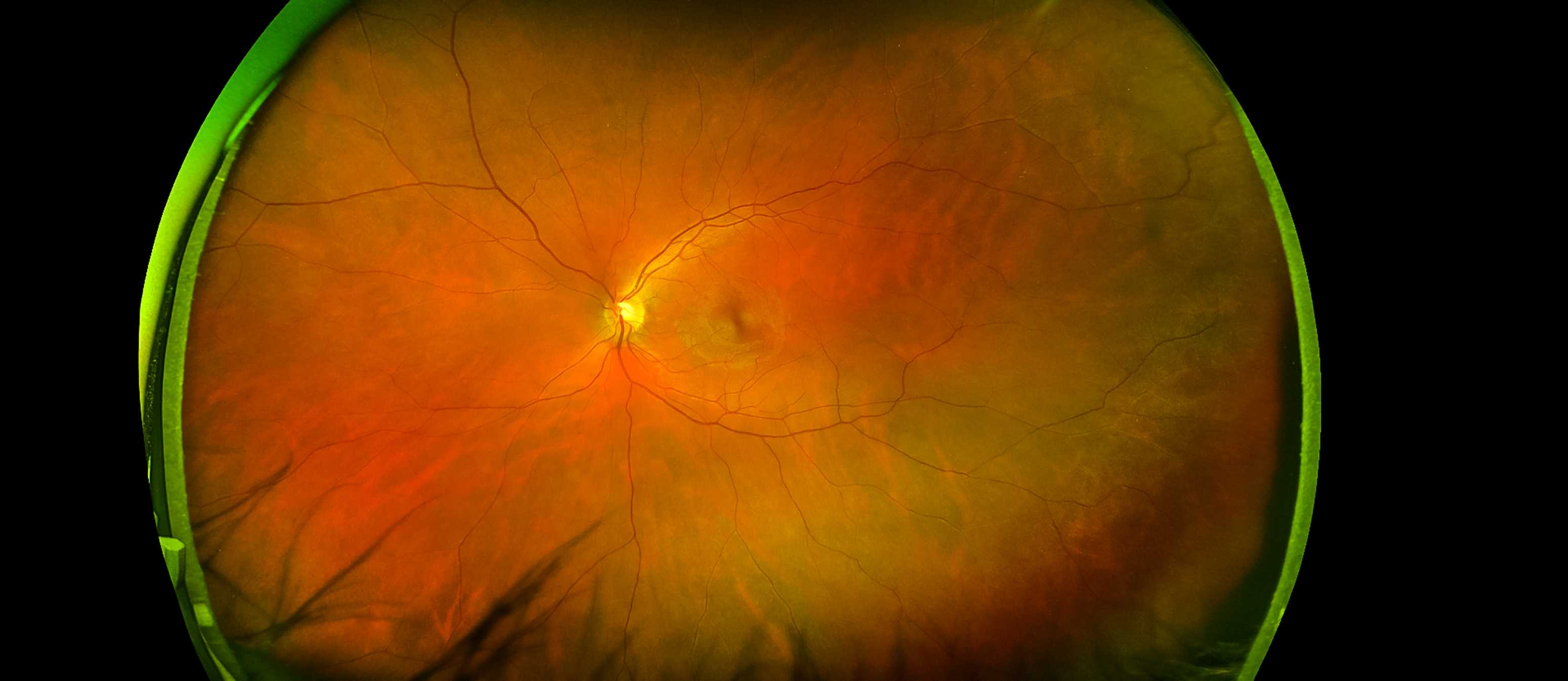 Device as small as 'grain of rice' offers hope for rare eye disease — WESH 2 Orlando