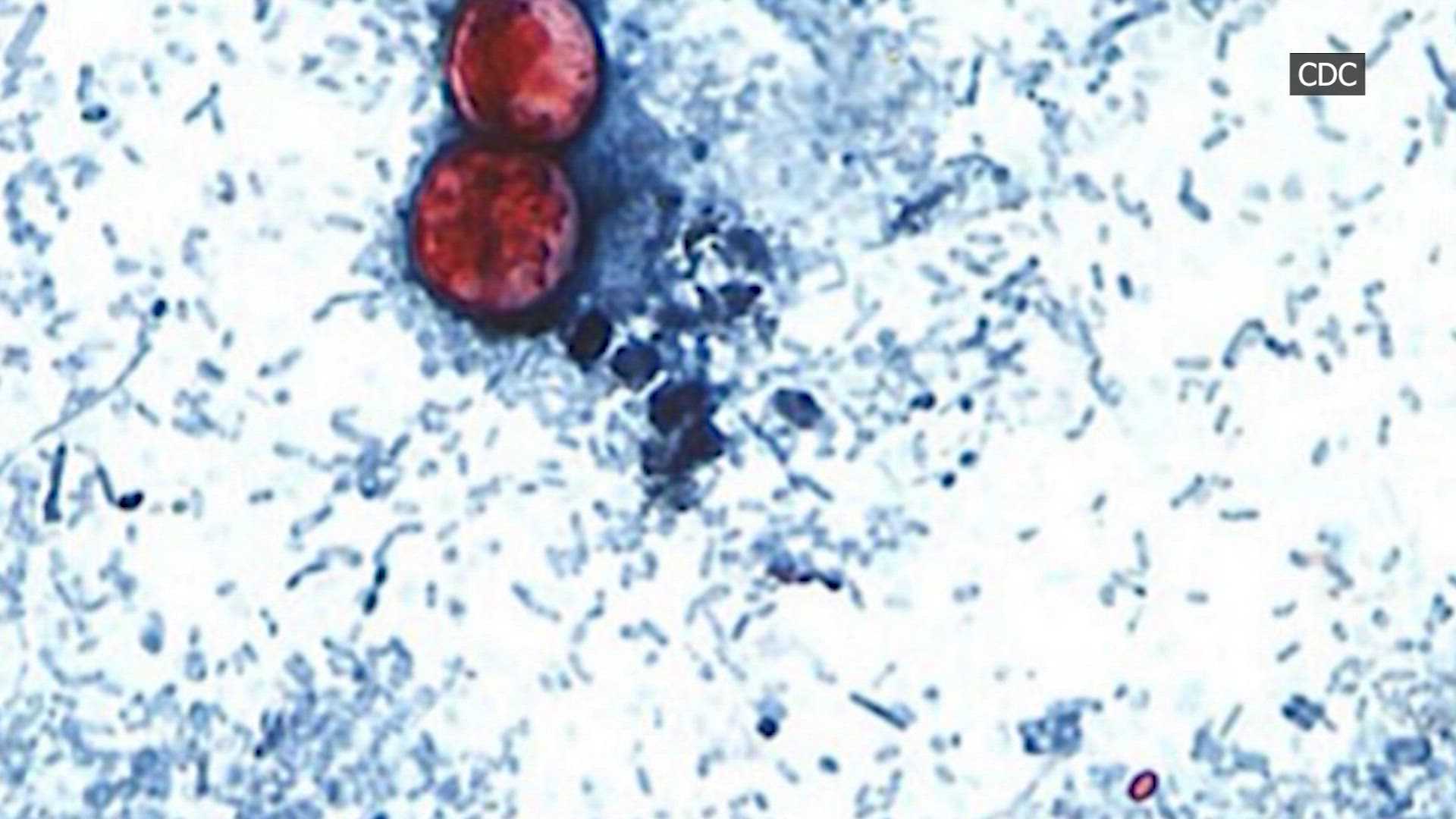 First deaths reported in cyclosporiasis outbreak — WESH 2 Orlando, Winter Park Health news